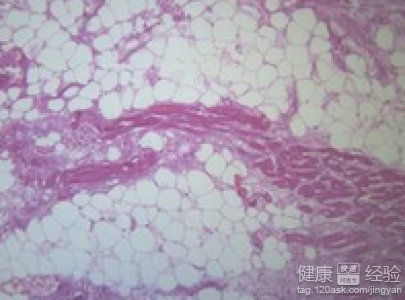 粉紅色泡沫痰可能是心肌梗塞的征兆