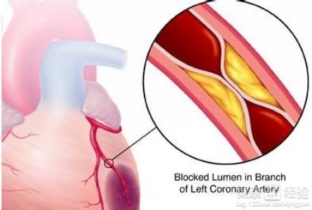 心肌梗塞容易引發的幾大並發症!
