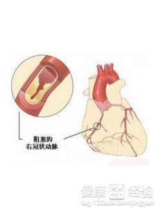 心肌梗死是什麼
