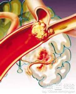 急性心肌梗死的概念