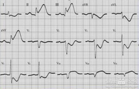 心肌梗死的誘因是什麼