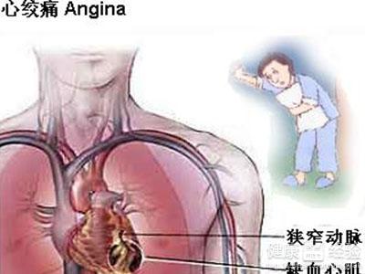 急性心肌梗死的首要護理措施