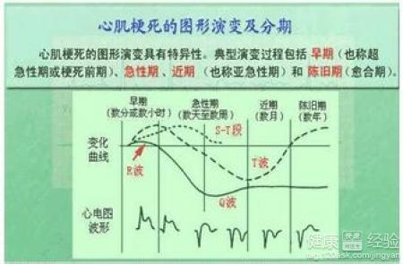 心肌梗死是冠心病嗎