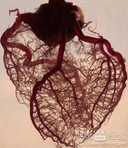 心肌梗死做支架好嗎