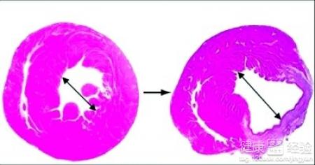 心肌梗死的危害