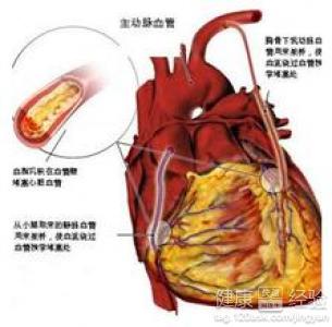 重度心肌梗死的治療方法