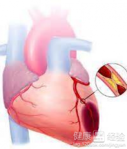 心肌梗死的康復護理