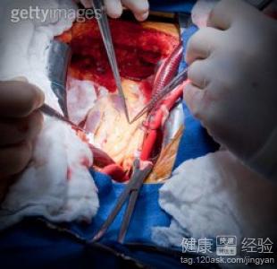 關於急性心肌梗塞的保健方法有哪些