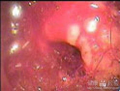 食管炎是否可以導致心肌梗塞