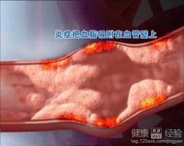 心肌梗塞是否會遺傳