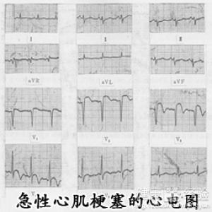 下壁心肌梗塞如何預防呢