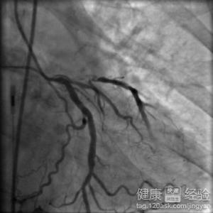 心肌梗塞出院後復診查什麼