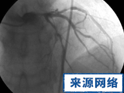 支架植入後有哪些需要注意? 冠心病 治療 支架 介入 預後 保健