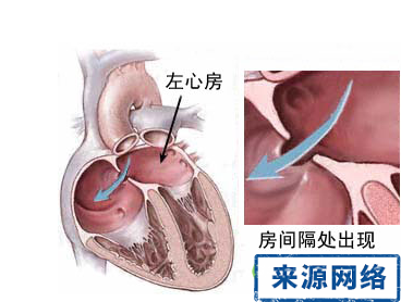 先心病 先天性心髒病 先心病症狀 先天性心髒病症狀