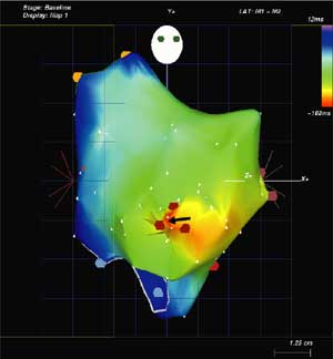心律失常飲食注意事項 心律失常飲食 心律失常飲食注意事項 心律失常不能吃什麼